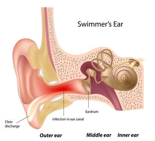 swimmer's ear
